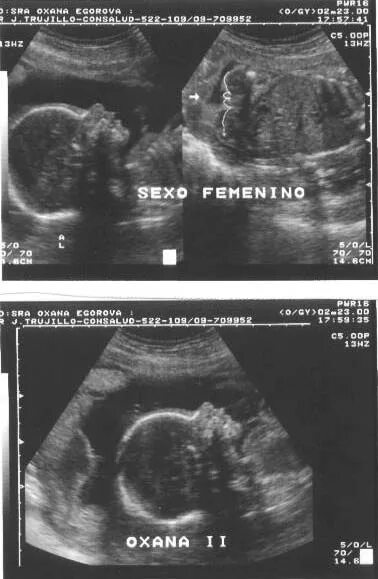 положение плода узи