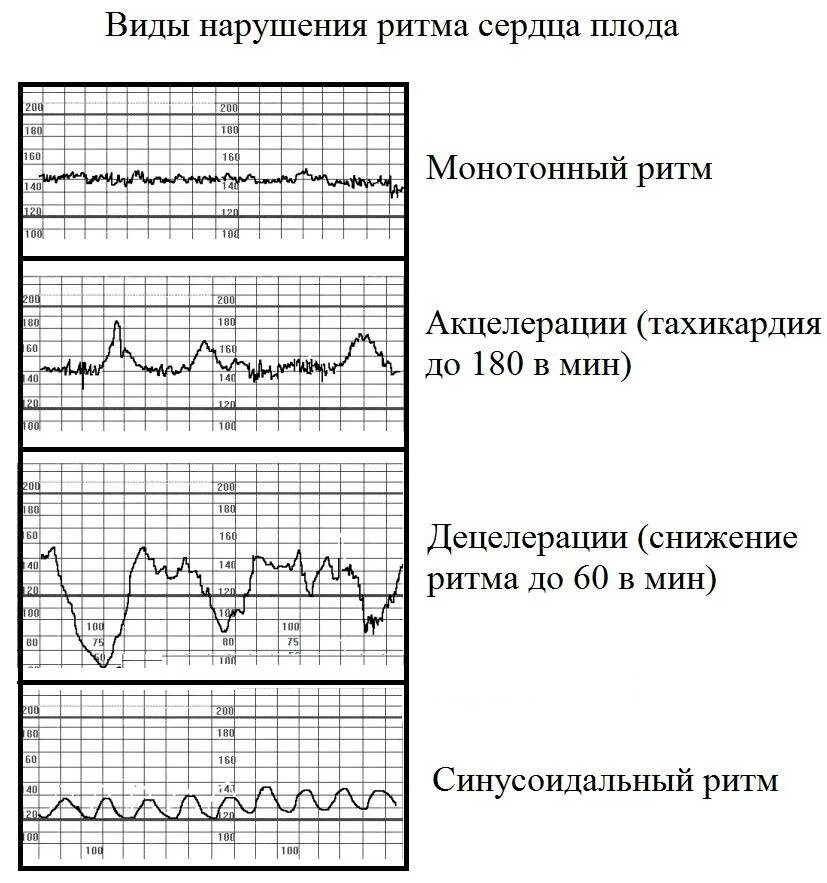 Исследование сердцебиения плода. Синусоидальный Тип КТГ плода. Монотонный ритм на КТГ. Вариабельность базального ритма на КТГ. Базальный ритм на КТГ норма.