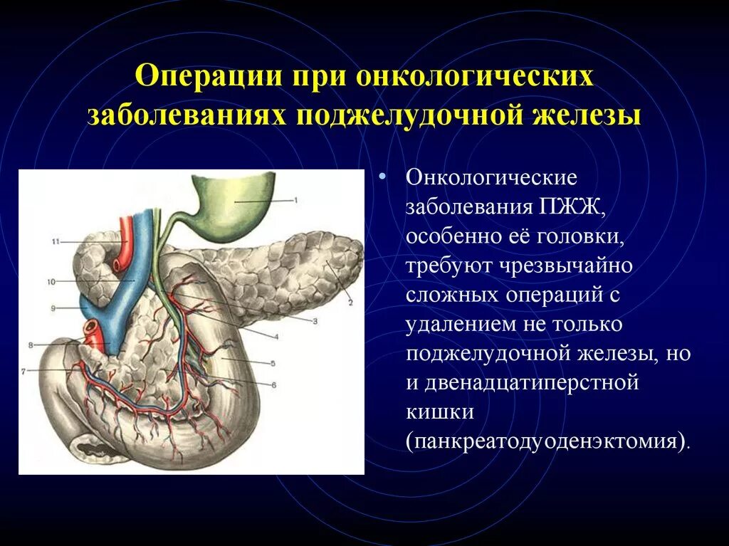 Поджелудочная маркеры. Операция Рамс поджелудочная железа. Операции при опухоли головки поджелудочной железы. Санториниев проток поджелудочной железы.