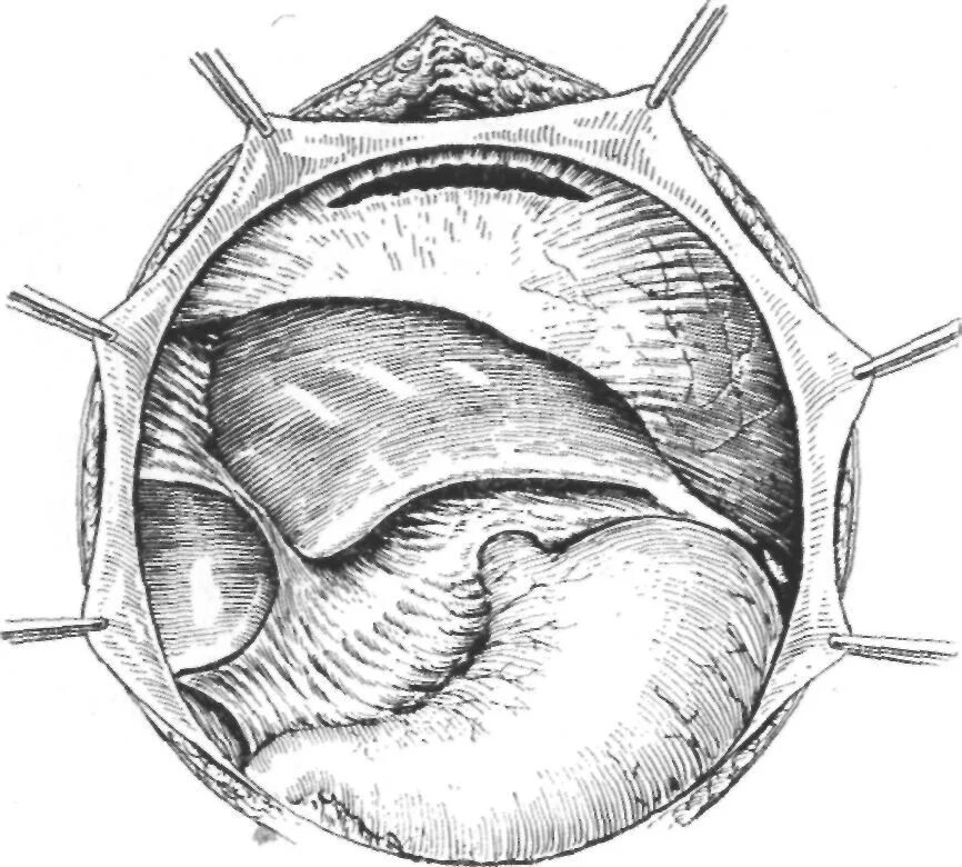 Паллиативная операция. Сущность хирургического метода лечения больных. Секвестрнекрэктомия операция. Гастростомия или еюностомия. Трансторакальная резекция пищевода.