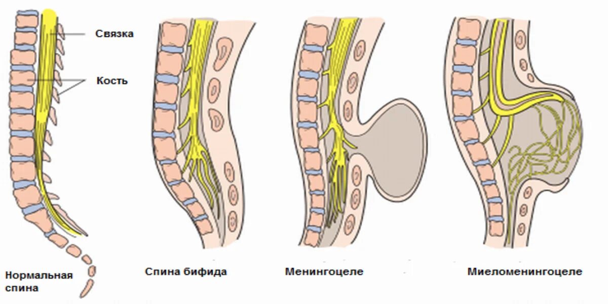 Спинномозговая грыжа. Спина бифида спинномозговая грыжа. spina bifida (расщепление позвоночника). грыжа спинного мозга спина бифида. спинномозговая грыжа менингоцеле.