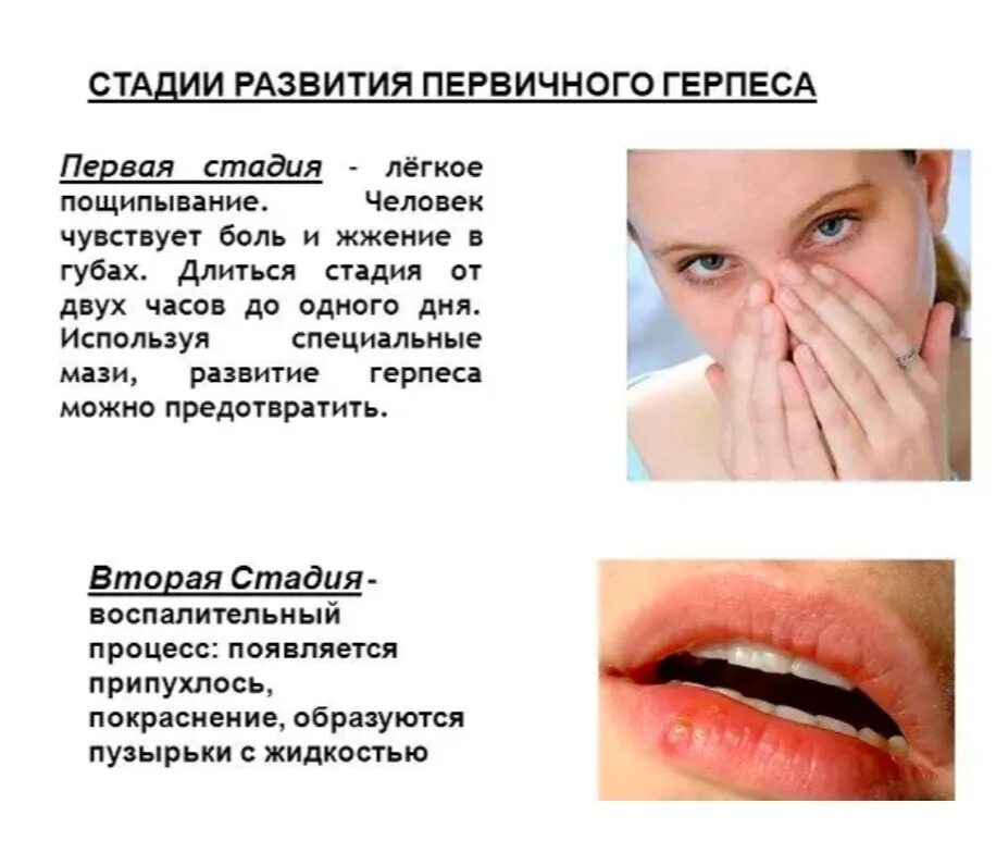 Герпес 1 типа у взрослых. Герпес на губе первая стадия. герпесные высыпания на губах.