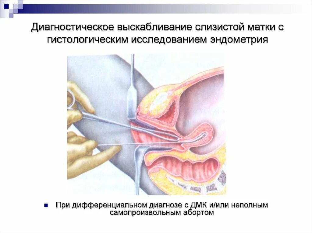 Кюретаж в гинекологии. Диагностическое выскабливание слизистой матки. Хирургическое выскабливание полости матки. Гистологическое исследование в гинекологии. Что такое гистологическое выскабливание.