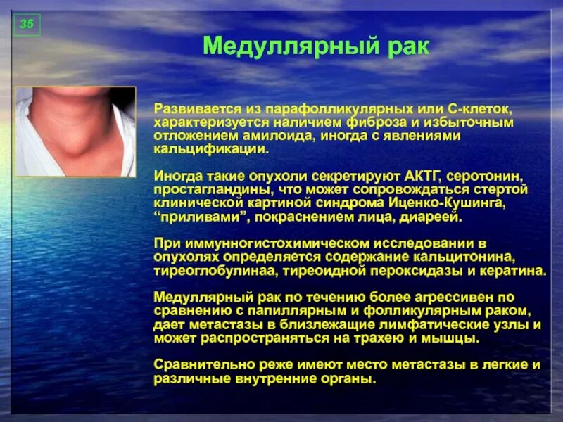 Медулярный рак. Медулярныйрак щитовидной железы. Медуллярная опухоль щитовидной. Медуллярная карцинома щитовидки. Спорадическая медуллярная карцинома щитовидной железы.