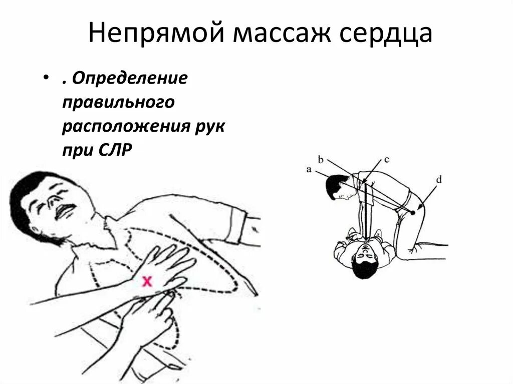 Аппарат для непрямого массажа сердца
