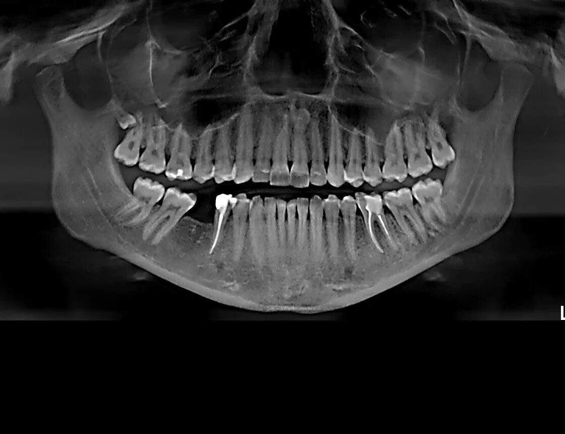 Снимок зубов видное. Ортопантомография (ОПГ). Панорамный снимок ОПТГ.