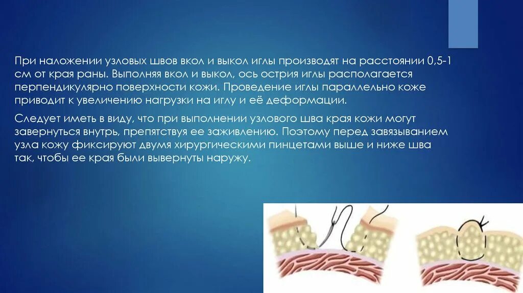 Вкол иглы