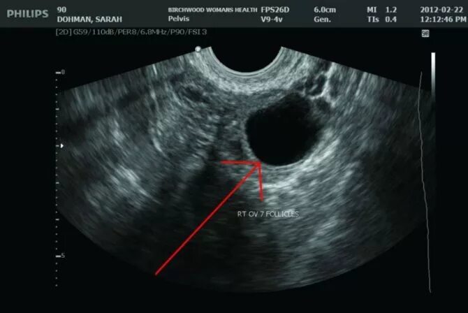 Лютеинизация фолликула на УЗИ. Доминантный фолликул на УЗИ. Фолликулометрия УЗИ доминантный фолликул. УЗИ яичников доминантный фолликул. Можно перепутать беременность с кистой