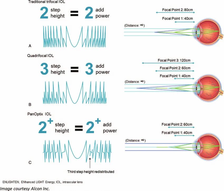 Американские алкон для глаза. Паноптикс ИОЛ. Алкон Паноптикс. Мультифокальная линза Паноптикс. Мультифокальные ИОЛ Алкон.