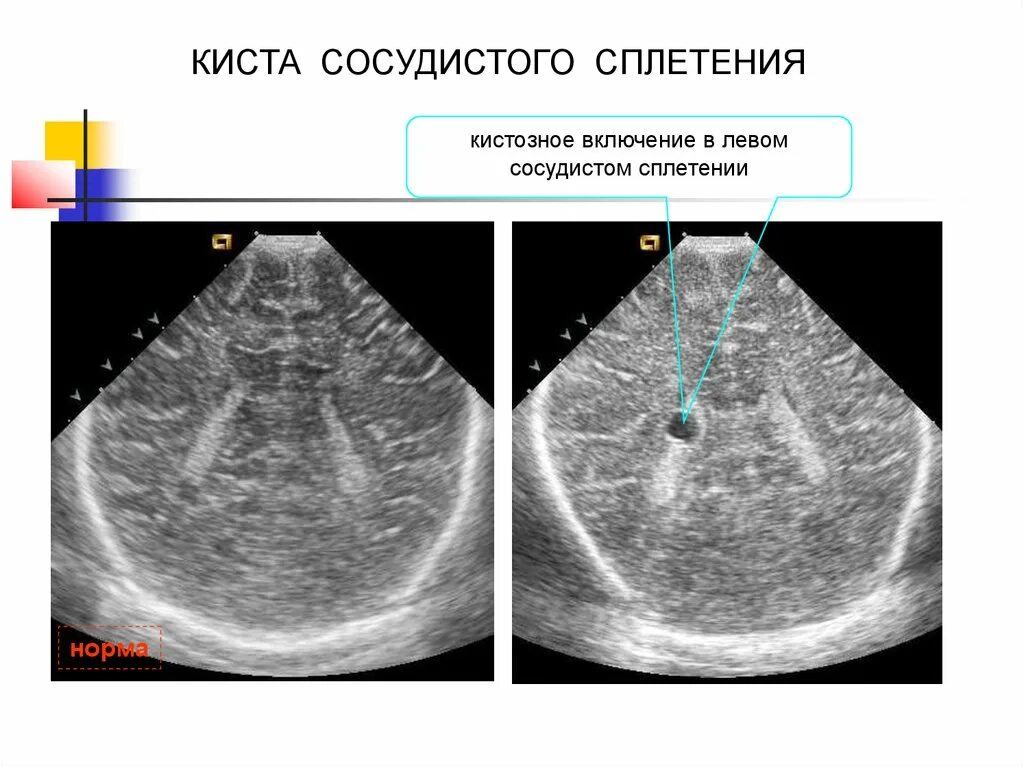 Нейросонография новорожденных кисты сосудистых сплетений. Киста сосудистого сплетения. Киста сосудистого сплетения головного мозга. Киста сосудистого сплетения УЗИ.