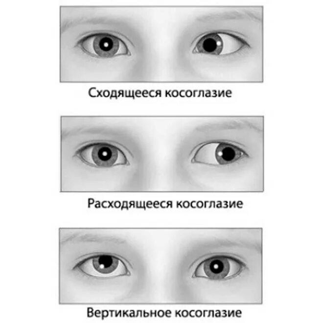 Почему у детей косоглазие. Содружественное сходящееся альтернирующее косоглазие. сходящееся содружественное косоглазие у детей. сходящееся альтернирующее косоглазие у детей. содружественное косоглазие схема.