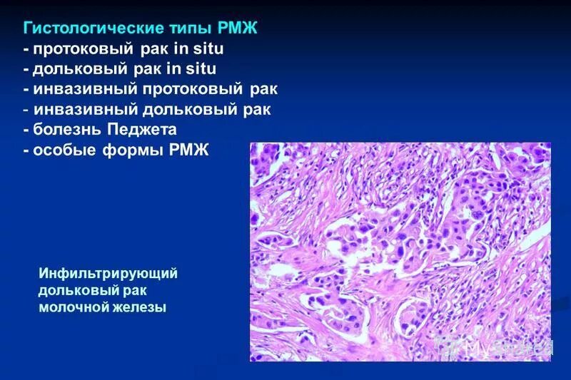 опухоль протоковая молочной железы. инфильтрирующая протоковая карцинома молочной железы g2. неинвазивная карцинома молочной железы. внутрипротоковая карцинома молочной железы микропрепарат. гистологический тип опухоли молочной железы.