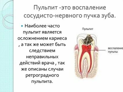 Воспаление пульпы