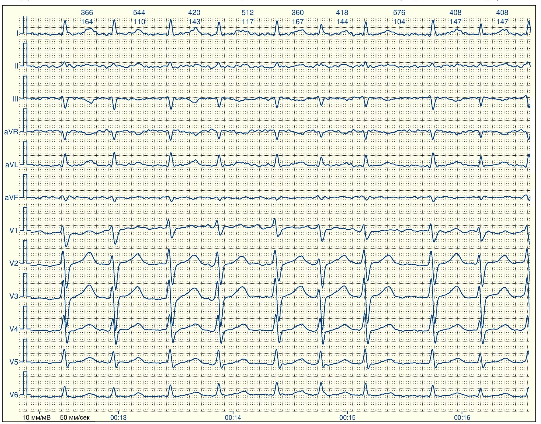 Брадикардия эос. Синусовая тахикардия на ЭКГ. ЭКГ С ЧСС 110. Риентри синусовая тахикардия на ЭКГ. Синусовая брадикардия ЭКГ 50 М.