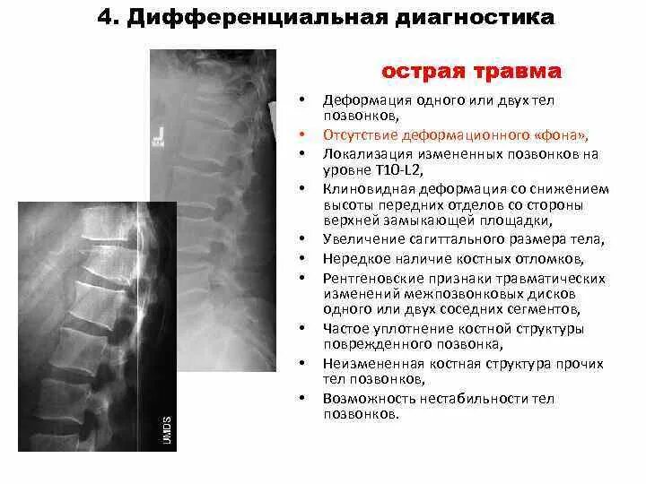 Компрессионный перелом позвоночника l1 операции. Компрессионный перелом с 4. Компрессионный перелом l1 l2 l3 позвонков последствия. Компрессионный перелом тела позвонка т 5.