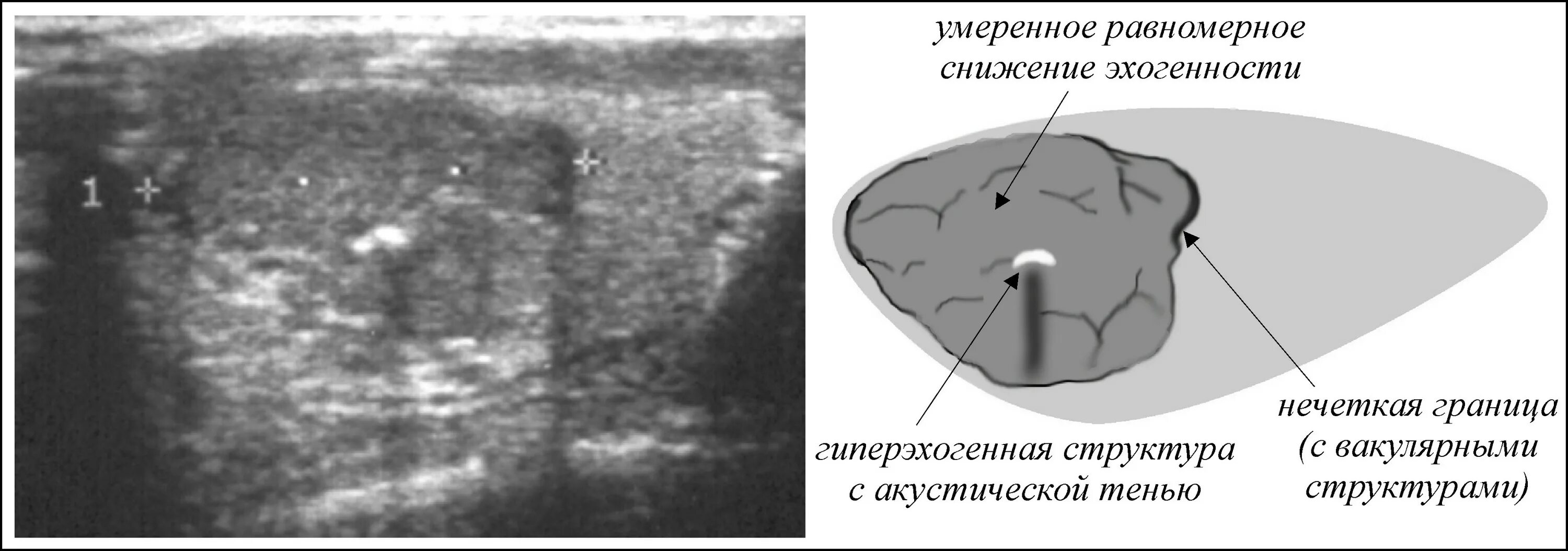 Умеренно диффузно неоднородная. Гипоэхогенное образование неоднородной структуры в щитовидной. Гиперэхогенный узел в щитовидной железе. Кальцинаты щитовидной железы. Микрокальцинаты узла щитовидной железы на УЗИ.