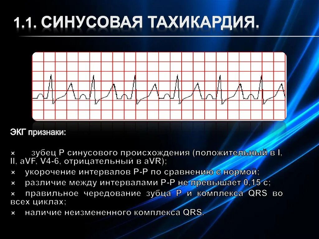 Синусовая тахикардия вертикальное. Синусовая тахикардия ЭКГ признаки. Синусовая тахикардия ЭКГ расшифровка. ЭКГ при синусовой тахикардии. ЭКГ зубцы синусовая тахикардия.