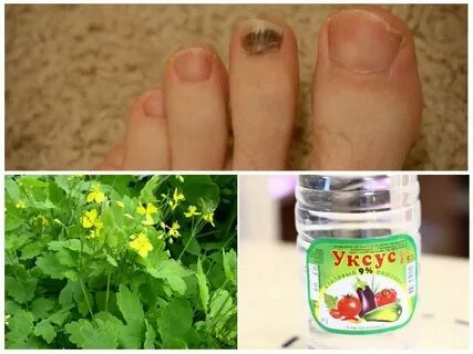 Народные средства для лечения ногтей