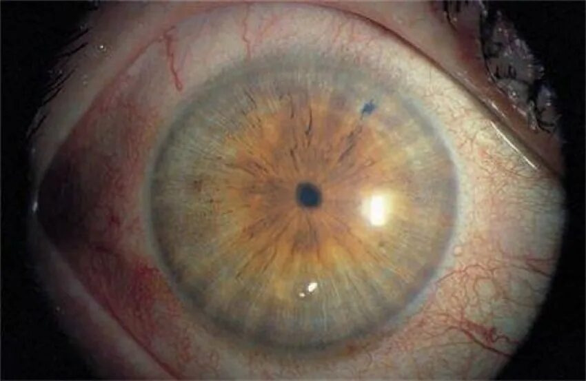 Нормальный зрачок и расширенный. Миоз сужение зрачка. Миоз мидриаз анизокория. Миоз сужение зрачка. Миоз мидриаз анизокория.