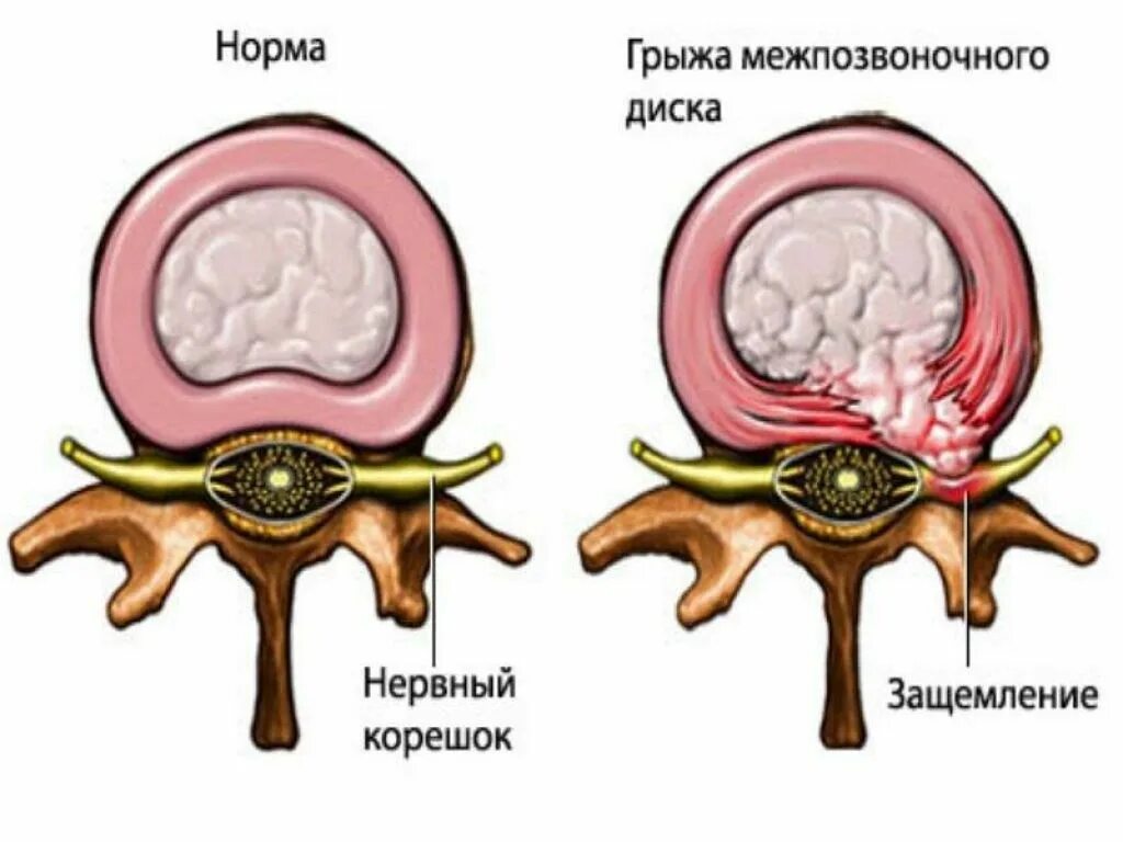 Симптомы межпозвоночной грыжи. Пульпозное ядро межпозвоночного диска гистология. Протрузия межпозвонковых дисков поясничного. Грыжа диска. Грыжа межпозвонкового диска.