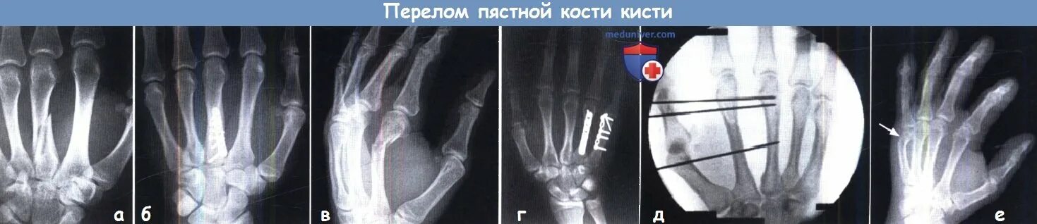 Картинки ПЕРЕЛОМ ЗАПЯСТЬЯ РУКИ СИМПТОМЫ