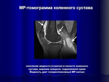 Гиперинтенсивный сигнал