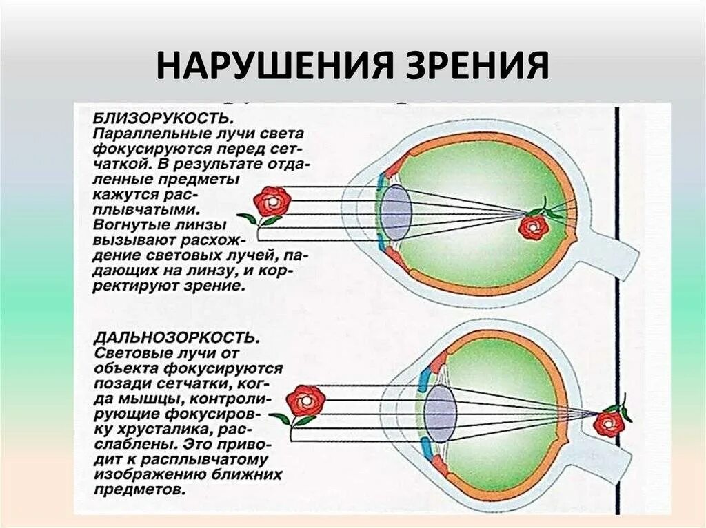 Нарушение зрения близорукость дальнозоркость. Проявления (симптомы) нарушений зрения (зрительного восприятия).. Зрительный анализатор дальнозоркость и близорукость. Заболевание 1)  близорукость 2)  дальнозоркость.