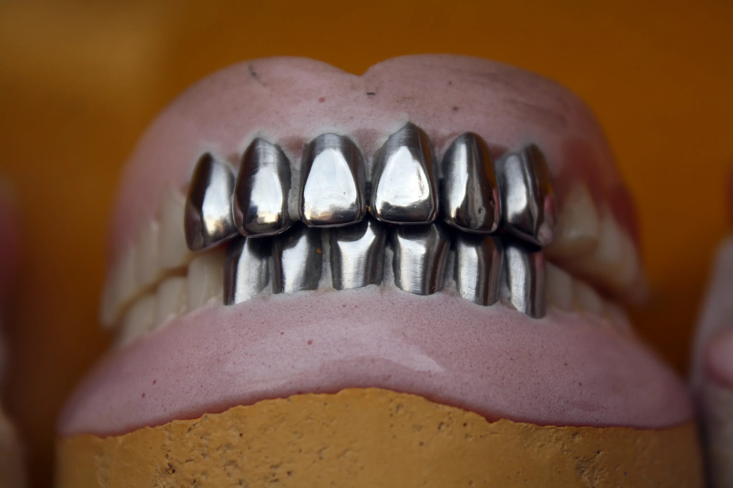 Штампованные коронки на зубы. Коронка цельнолитая КХС. Мостовидные протезы металл цельнолитые. Цельнолитой мостовидный протез. Цельнолитая коронка (КХС С напылением).