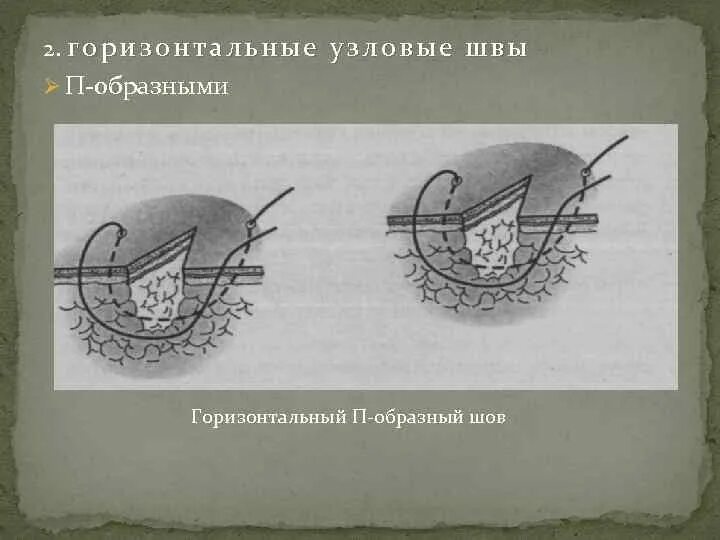 Х образный шов. Кишечный хирургический шов Мультановского. Горизонтальный матрацный п-образный шов. Портняжный шов хирургия Шмидена. Горизонтальный п образный шов.