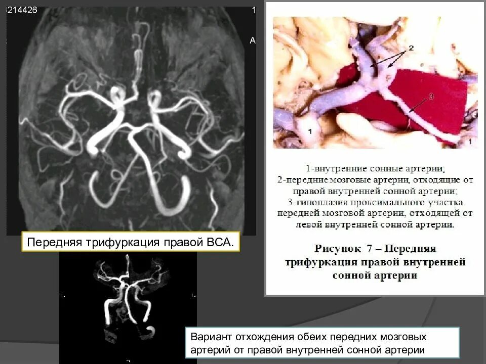 Правая задняя трифуркация. Задняя трифуркация внутренней сонной артерии мрт. Передней трифуркация внутренней сонной артерии. Трифуркация правой внутренней сонной артерии что это такое на мрт. Трифуркация задней мозговой артерии.