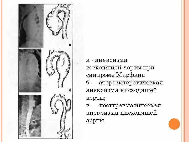 Аневризма нисходящего отдела аорты. Аневризматическое расширение восходящего отдела аорты. расширение нисходящего отдела грудной аорты. аневризма и аневризматическое расширение. аневризма нисходящего отдела грудной аорты.