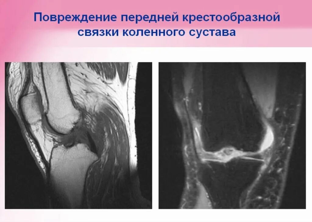 Повреждение передней крестообразной связки коленного сустава мрт. Разрыв передней крестообразной связки коленного сустава мрт. Снимок мрт коленного сустава. Мрт здорового коленного сустава. Полный разрыв передней крестообразной