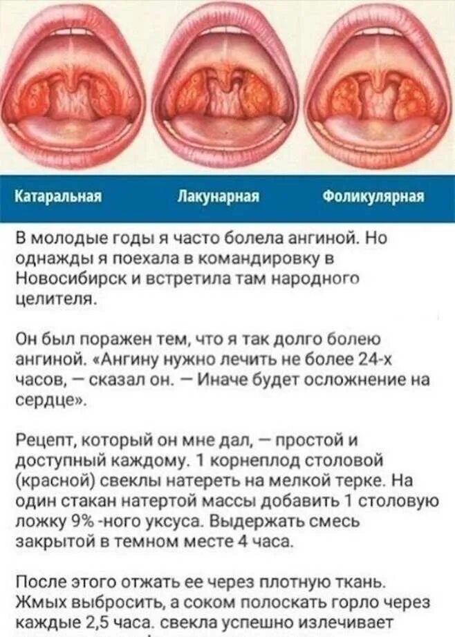 Почему постоянно першит. Ангина лакунарная катаральная.