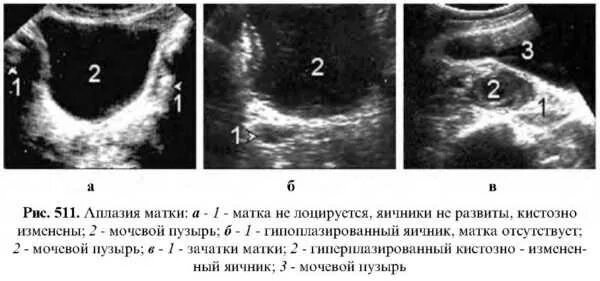 Гипоплазия матки на УЗИ. Гипоплазия матки УЗИ критерии.