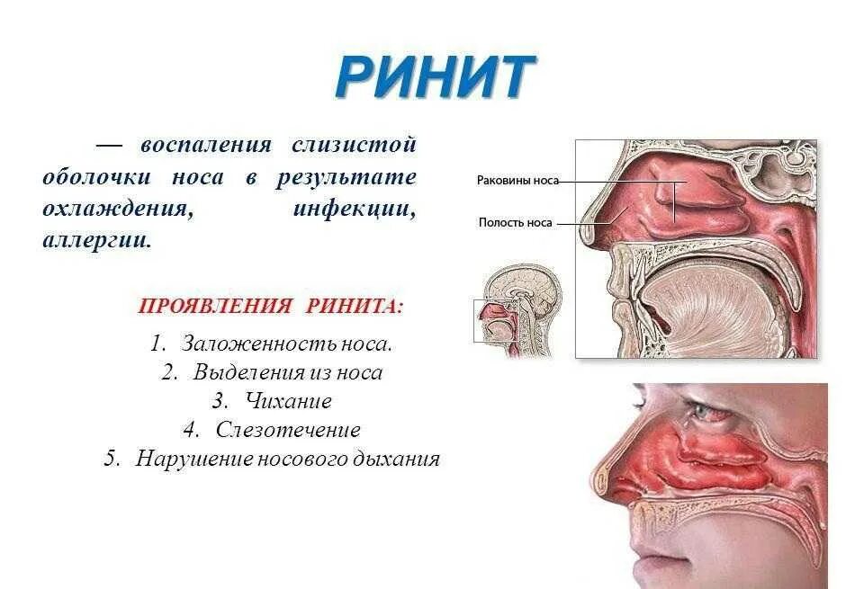 Заложенность носа болит горло. Ринит это заболевание носовой полости. Слизистая оболочка носа при аллергическом рините. Воспаление слизистой оболочки носовой полости. Аллергический ринит вазомоторный ринит.