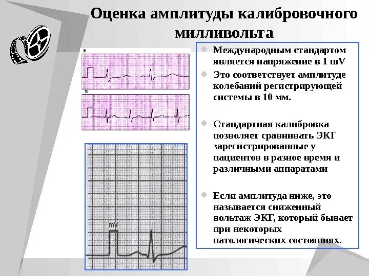 Вольтаж ЭКГ норма. ЭКГ низкий Вольтаж зубцов в стандартных отведениях. Уменьшение вольтажа на ЭКГ. Вольтаж зубца r на ЭКГ. Мв на экг