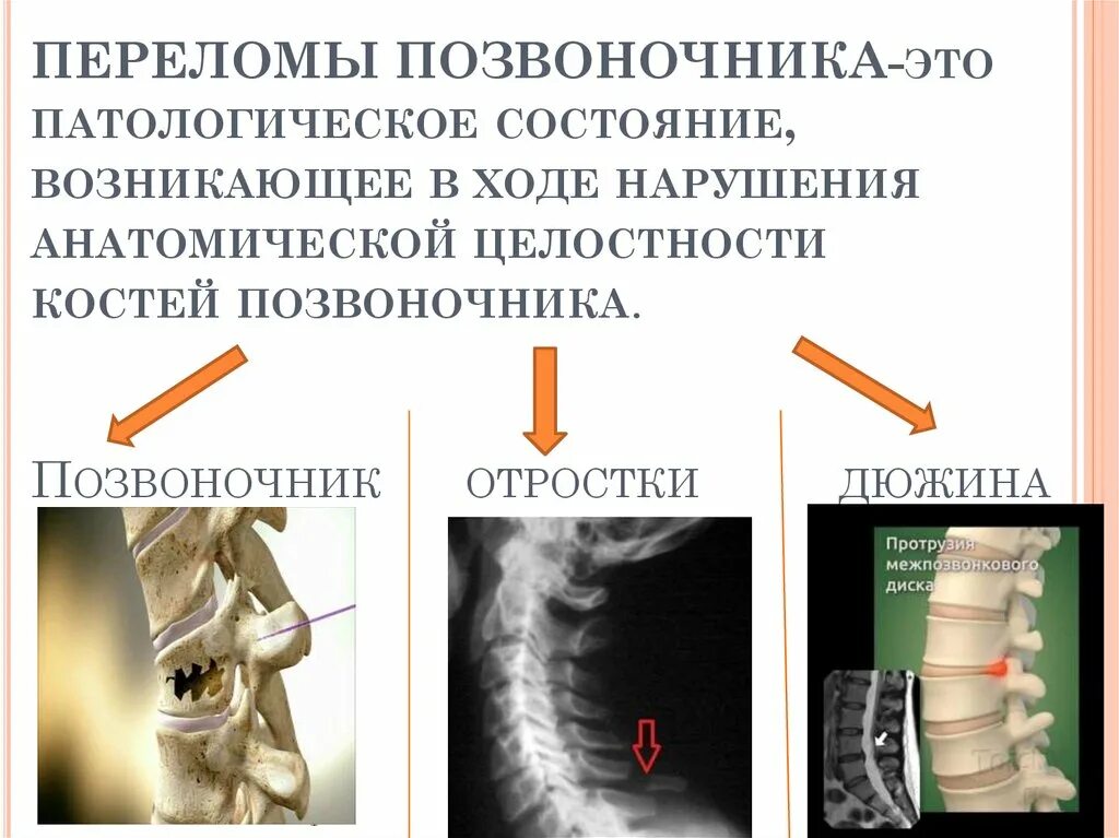 Позвоночник компрессионный перелом th9. Патологический компрессионный перелом позвонка. Компрессионный перелом l1 позвонка. Компрессионный перелом тела l позвонка.