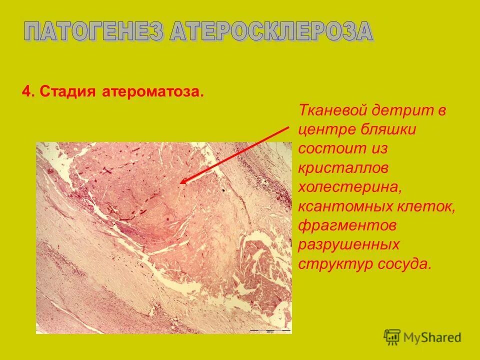Атеросклероз аорты стадии. Атеросклероз аорты патанатомия. стадии атеросклероза патологическая анатомия. патогенез атеросклероза патанатомия. этиология атеросклероза патанатомия.