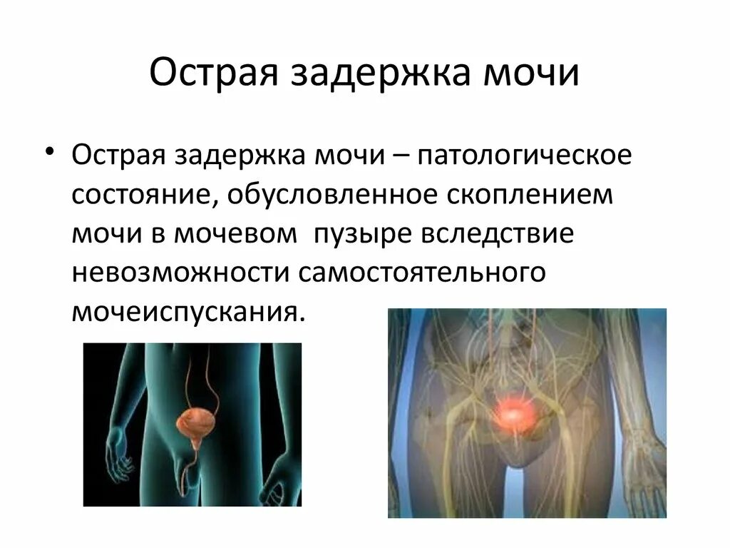 Почему задержка мочи. Симптомы острой задержки мочеиспускания. Задержка мочи. Остострая задержка мочи. Острая задержка мочи симптомы.