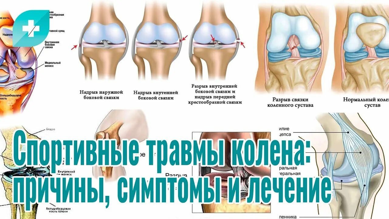 Биоимплант суставов спб. Биоимплант коленного сустава. Биоимплант тазобедренного сустава. Факторы риска травмы коленного сустава.