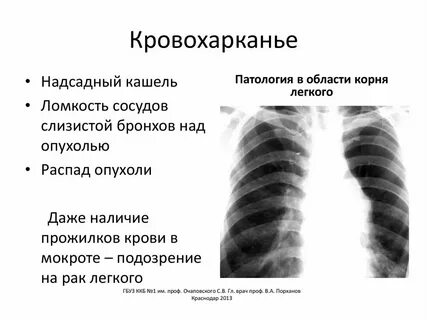 Кашель с кровью при простуде без температуры