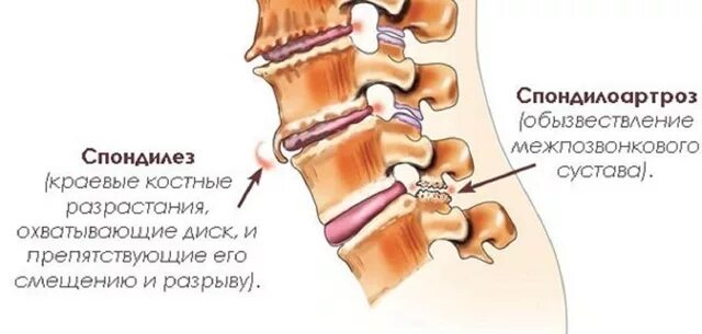 Краевые костные разрастания тел позвонков шейного отдела. Задние краевые остеофиты тел l2-s1. Краевые остеофиты тел позвонков рентген. Остеофиты l4 l5 позвонков. Задние остеофиты позвонков с4-с5.