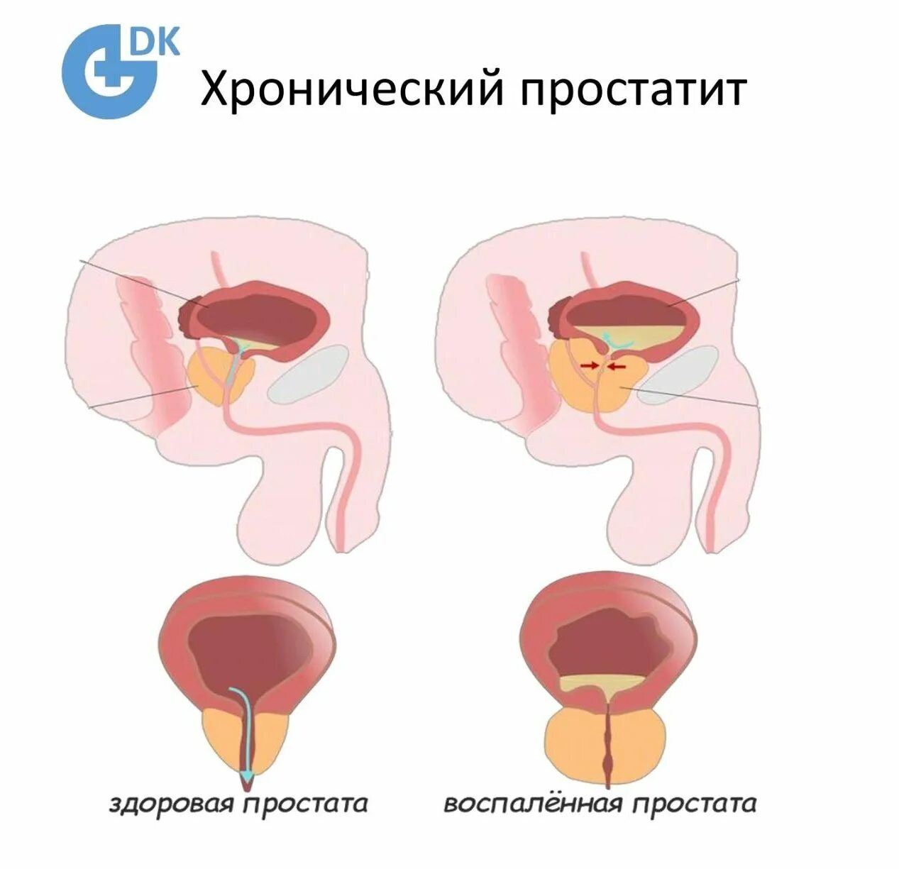 Простата урок. Хронический простатит. Воспаление предстательной железы. Простата у мужчин.