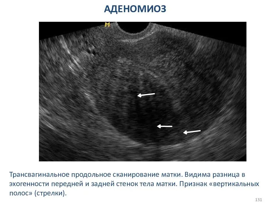 Внутренний эндометриоз матки на УЗИ. Внутренний эндометриоз на УЗИ. Эндометриоз аденомиоз матки.