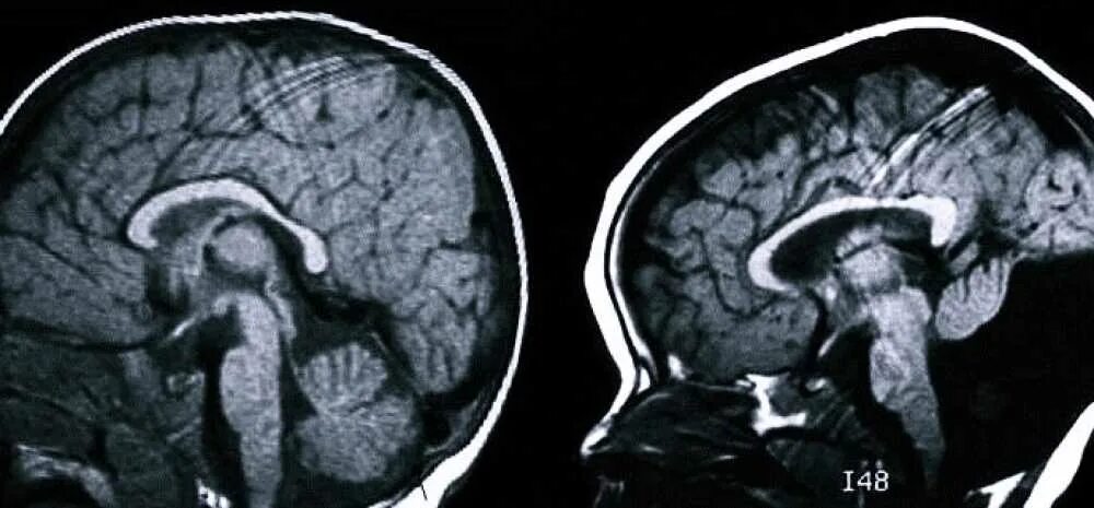 Гипоплазия червя. Гидроцефалия Денди Уокера. Мальформация Денди Уокера мрт. Гипоплазия мозжечка, аномалия Денди-Уокера. Денди-Уокера аномалия УЗИ.
