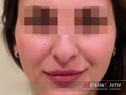 Ринопластика отек сколько
