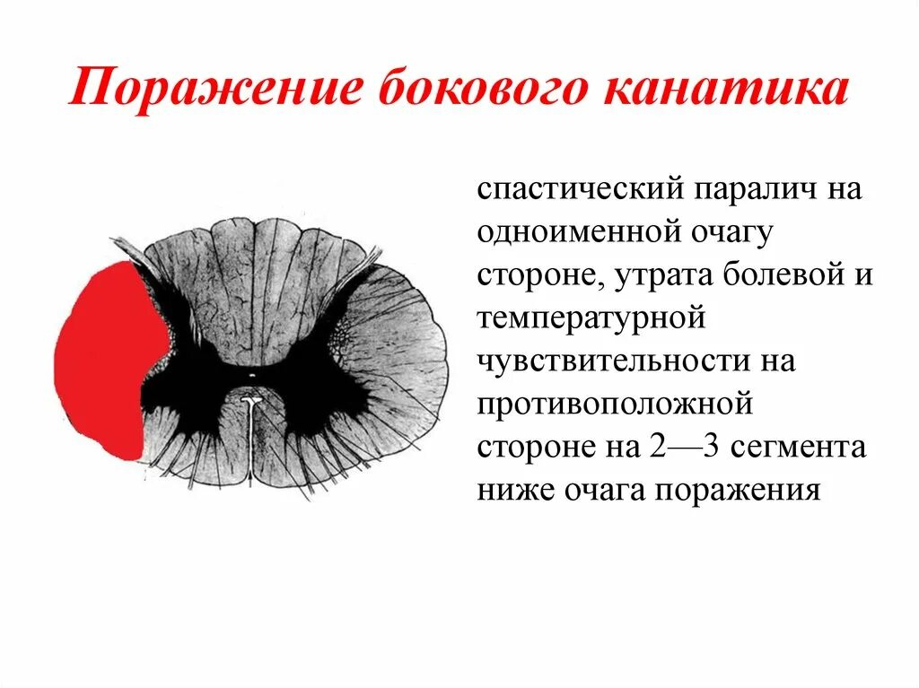 Поражение передних рогов. Синдром поражения задних канатиков спинного мозга. Синдром поражения бокового рога спинного мозга. Синдром поражения боковых Рогов спинного мозга. Синдром поражения бокового канатика спинного мозга.