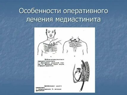 Медиастинит хирургия