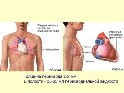 Жидкость в полости перикарда