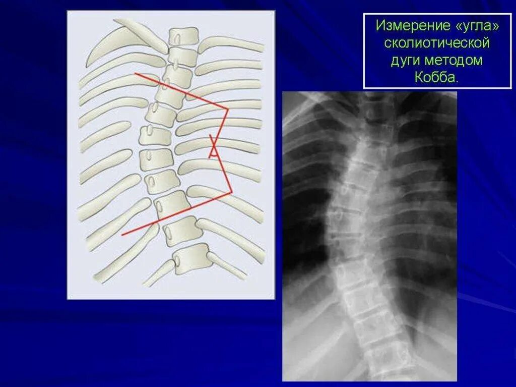Метод Кобба сколиоз рентген. Угол сколиоза по коббу рентген. Рентген сколиоз угол Кобба. Степени сколиоза по рентгену. Угол кобба